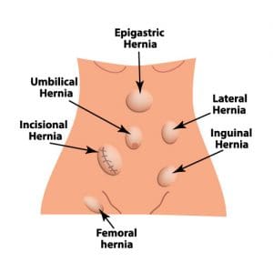 Hernia Surgery - Central Surgical Associates